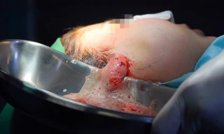 Nghe lời chiêu dụ tiêm filler để trẻ hóa, cô gái bị hoại tử mặt