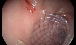 Đặt khung kim loại trong lòng ruột, cứu bệnh nhân ung thư chờ chết