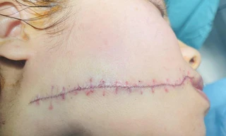 Chia tay, cô gái trẻ bị bạn trai rạch mặt