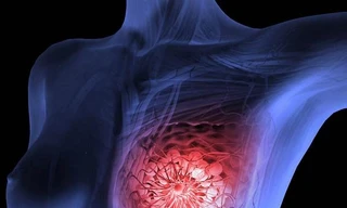 Các bước tự kiểm tra 'núi đôi' tại nhà, phát hiện sớm ung thư vú