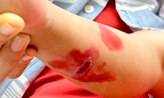 Bố mẹ tự chữa, nhiều trẻ nhập viện vì bệnh trở nặng