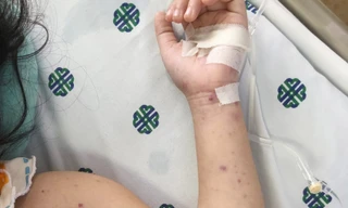 TPHCM: Khoanh vùng, theo dõi người tiếp xúc với bệnh nhi bị viêm não mô cầu