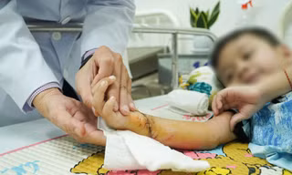 Đi bộ trên đường, bé 5 tuổi bị xe máy gây tai nạn đứt lìa bàn tay