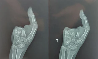 'Trồng' 2 ngón chân vào bàn tay bị máy xay thịt nghiền nát