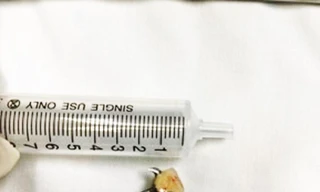 Chiếc răng giả 3 chân khiến nữ bệnh nhân gặp họa