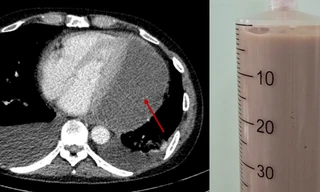 Tưởng bệnh vặt không ngờ suýt chết vì bệnh hiếm gặp