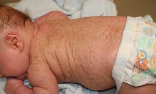 Bệnh vảy nến ở trẻ em ngày càng gia tăng