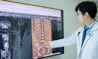 Sỏi san hô 'ăn' hết thận bệnh nhân