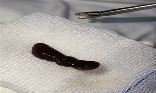 Con vắt sống trong mũi bé trai 18 tháng tuổi