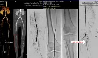 Tắc mạch máu khiến nữ bệnh nhân suýt cụt chân