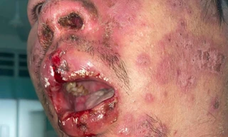 Toàn thân lở loét vì mắc bệnh lý hiếm gặp trên thế giới