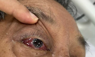 Chỉ đỏ mắt, ù tai, nam bệnh nhân đột ngột xuất huyết não, hôn mê