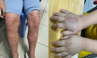 Cảnh báo biến chứng suy thận suốt đời từ viêm mạch máu ở trẻ