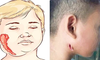 BS Trương Hữu Khanh nói về căn bệnh bị gọi tên 'vi khuẩn ăn thịt người'