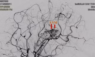 Bé gái 12 tuổi bị đột quỵ