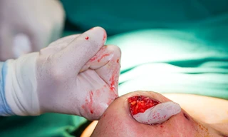 Tự tiêm thuốc tan mỡ, bụng bệnh nhân hoại tử trào mủ như 'núi lửa'