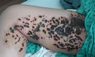 Đùi cô gái trẻ lở loét như tổ ong sau khi đốt điện chữa rạn da