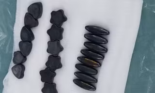 Bé trai mất một đoạn ruột vì nuốt 20 viên nam châm