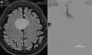 Người phụ nữ thoát 'án tử' u não nhờ... tai nạn giao thông