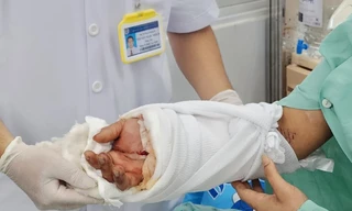 Nam thanh niên bị máy dập lìa cổ tay lúc nửa đêm