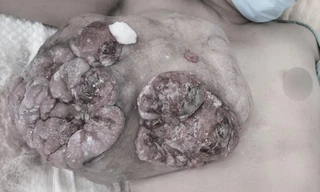 Trì hoãn điều trị để sinh con, người mẹ mất một bên ngực