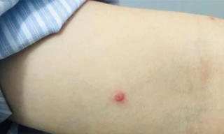 Sức khỏe ca bệnh đậu mùa khỉ đầu tiên ở Việt Nam ra sao?