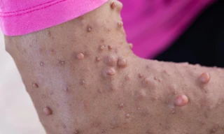 Khám sàng lọc miễn phí bệnh lý u sợi thần kinh