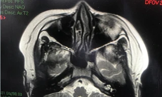 Bệnh nhi bị tổn thương não hiếm gặp hậu COVID-19