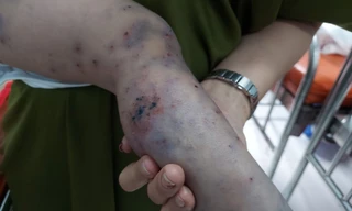 Bệnh nhi 3 tuổi tử vong vì bệnh tay chân miệng sau 15 phút nhập viện