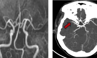 Người phụ nữ liên tiếp bị 2 cơn đột quỵ
