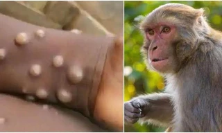 TPHCM khẩn cấp ứng phó bệnh đậu mùa khỉ