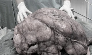 Người đàn ông ở TPHCM mang 'bụng bầu' nặng gần 18kg