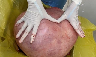 Nữ bệnh nhân nhiều năm mang u quái khổng lồ 11 kg vì nghĩ... mình mập