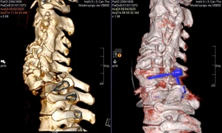Trèo cây hái xoài, người đàn ông trượt chân té gãy cổ