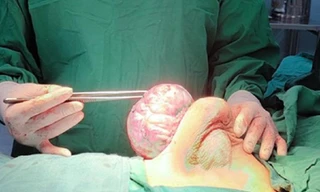 Thiếu nữ mới 15 tuổi đã mang khối u vú 'khổng lồ'
