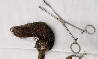 Búi tóc khoảng 1kg căng phồng chiếm trọn lòng dạ dày bé gái 5 tuổi