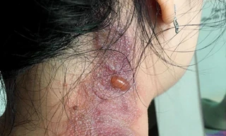 Cảnh báo hiểm họa kiến ba khoang 'tấn công' người trong mùa mưa