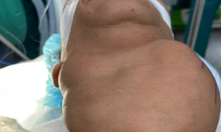 Cứu nữ bệnh nhân nhiều năm bị khối bướu 'bóp cổ'