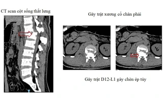Rơi thang máy, 2 công nhân trọng thương