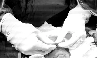 Cứu kịp thời thiếu niên nguy kịch vì bệnh xuất huyết hiếm gặp trong đường tiêu hóa