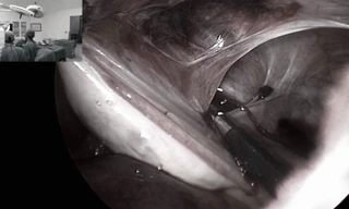 Đau bụng dữ dội, tắc ruột vì nguyên nhân phụ nữ thường gặp sau sinh mổ