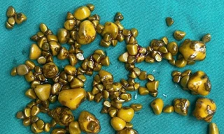 Người phụ nữ 'giấu cả trăm cục vàng' trong... túi mật