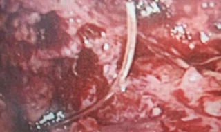 Cụ ông suýt mất mạng vì chiếc xương cá