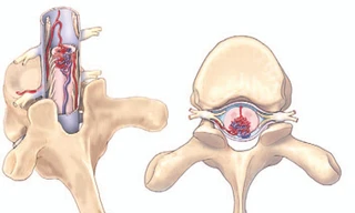 Bệnh nhân đột ngột liệt nửa người, bác sĩ phát hiện bệnh rất hiếm gặp