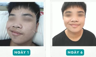 Bệnh 'khẩu nhãn oa tà' khiến nam sinh bất ngờ liệt nửa mặt