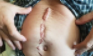 Vết sẹo dài trên bụng ông T. do bị đâm.