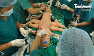 CLIP: Bên trong phòng mổ tách cặp song sinh dính nhau ở TPHCM