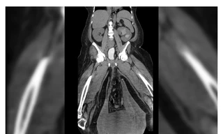 Hình ảnh chụp cắt lớp tinh hoàn của người đàn ông Panams