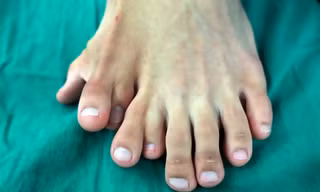 Người đàn ông có 9 ngón chân ở chân trái.