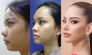 Tân Hoa hậu Hoàn vũ Thái Lan 2022 lộ ảnh trước khi phẫu thuật thẩm mỹ